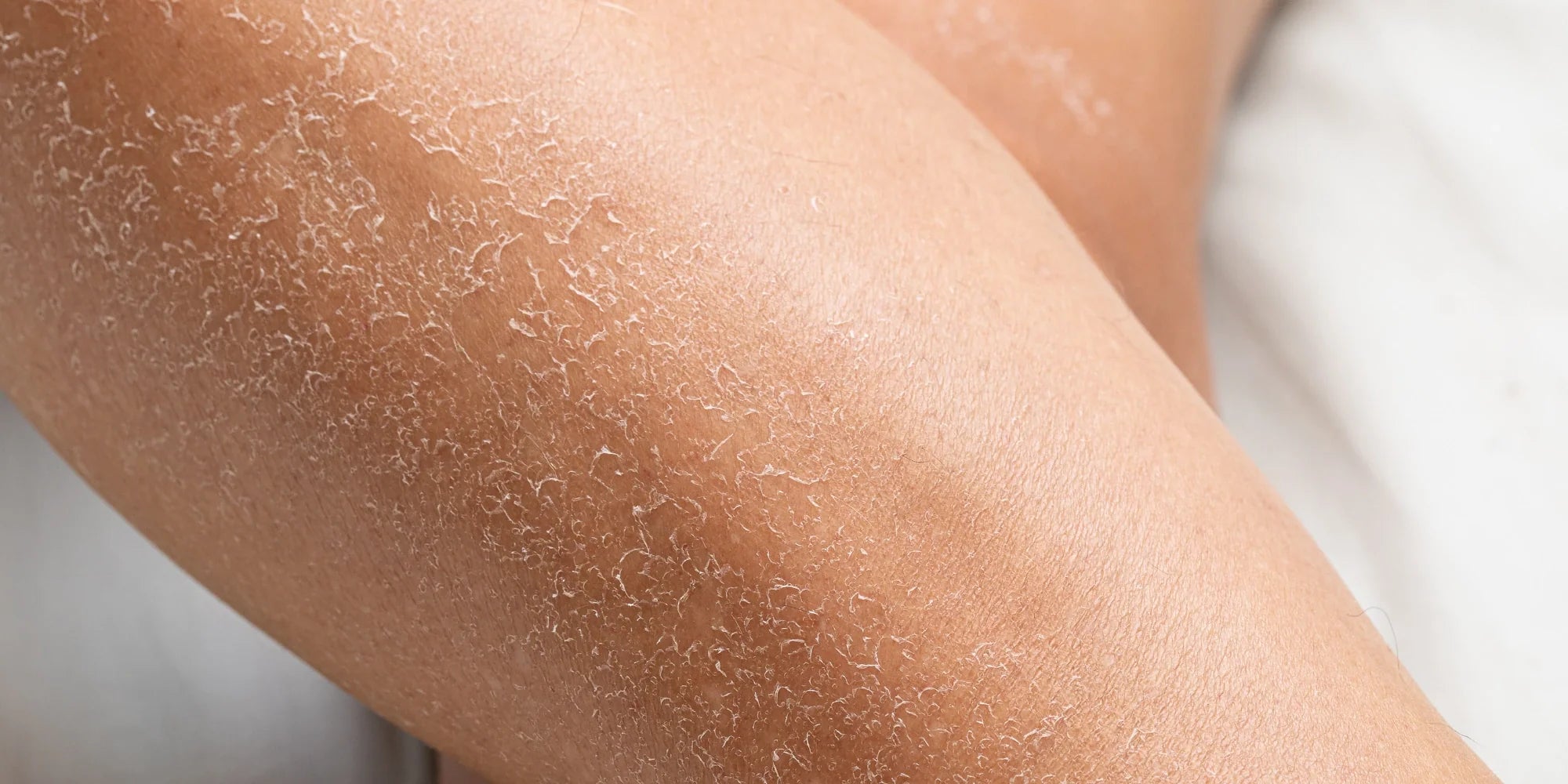 Votre peau tire après le soleil ?