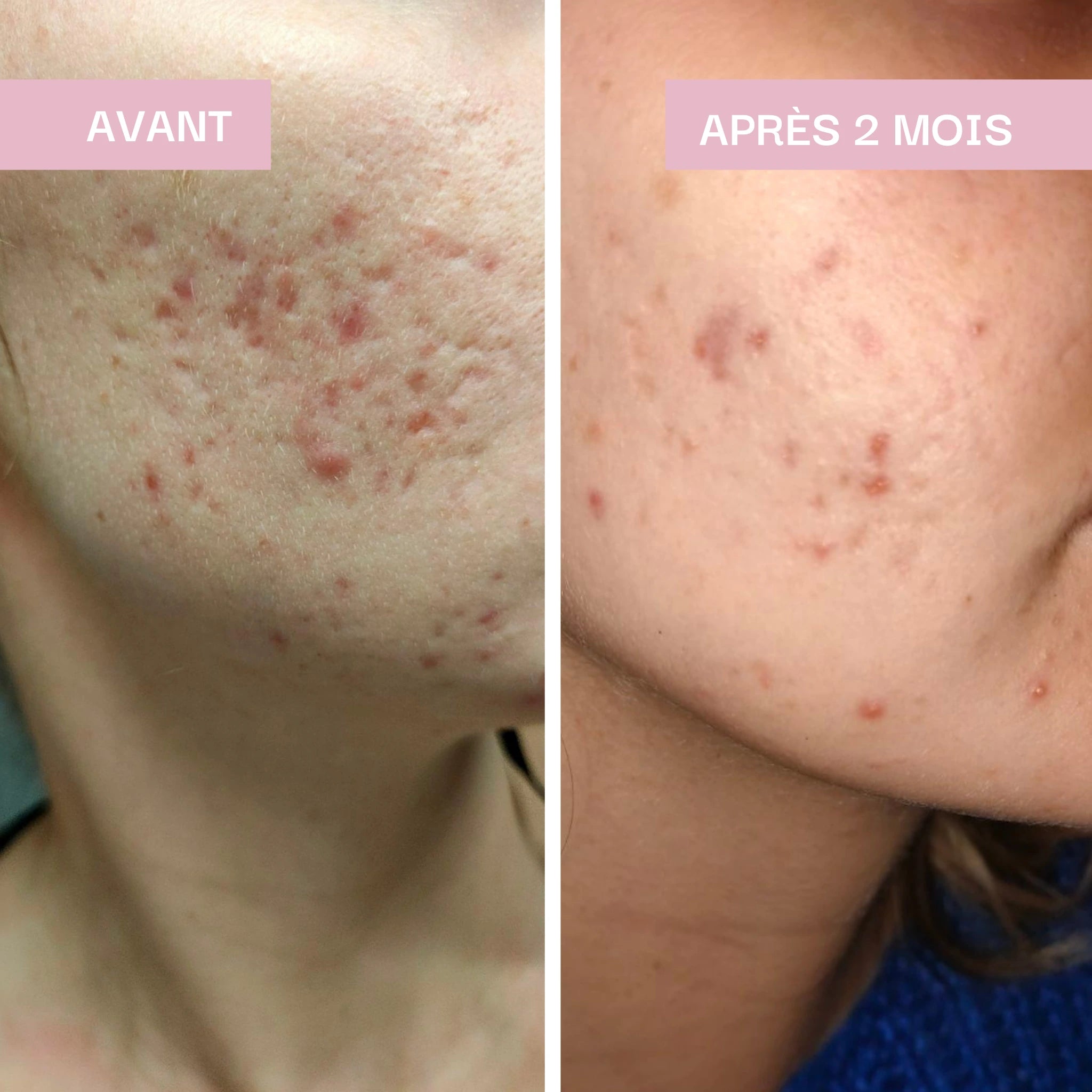 Imperfections & Peau purifiée : Détox Beauté