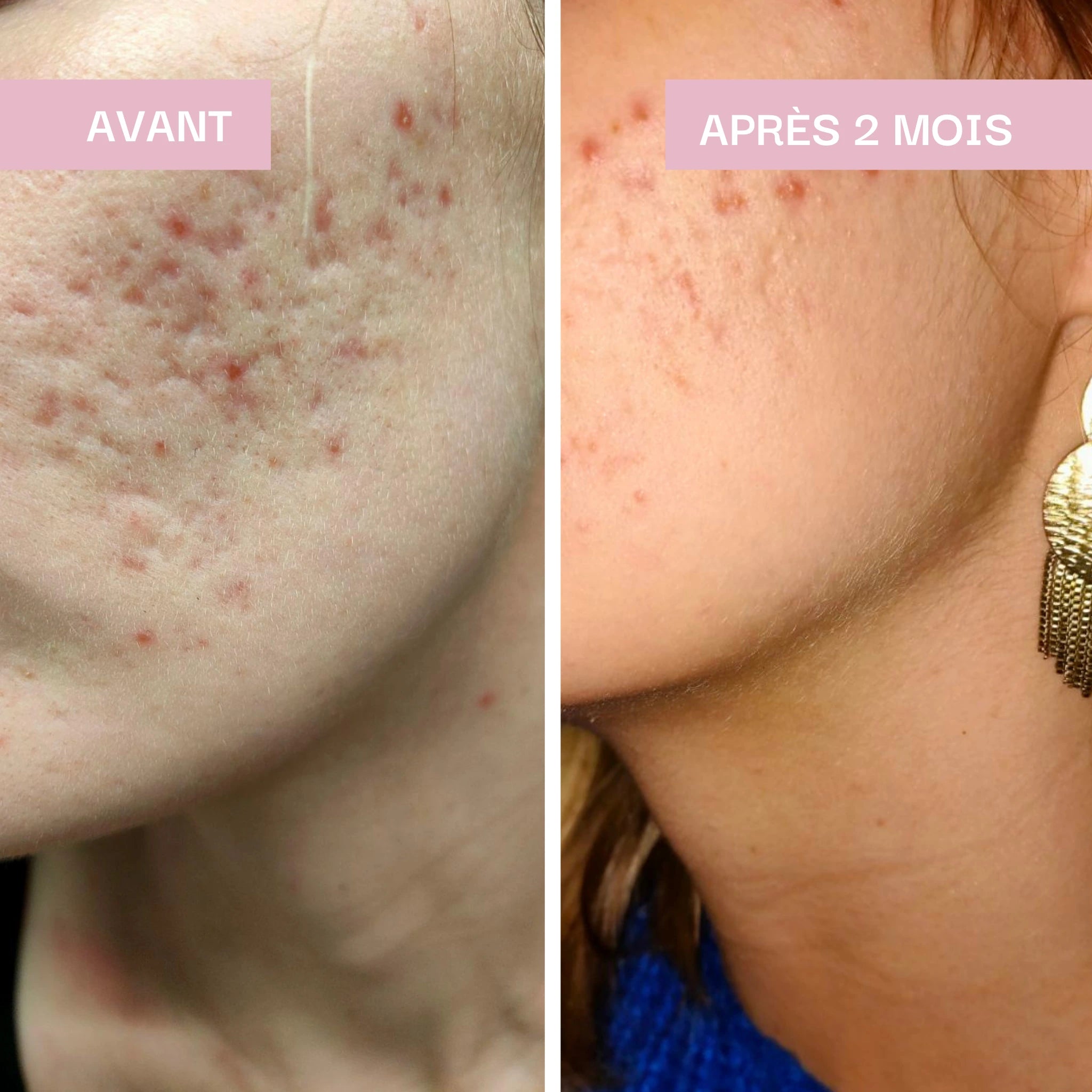 Imperfections & Peau purifiée : Détox Beauté